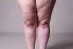 Lipedema e linfedema: compreenda as distinções e como abordar o tratamento