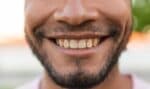 7 Alimentos e Hábitos que Escurecem os Dentes
