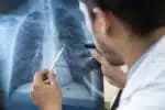 Identifique o que é pneumonia silenciosa, que tem alertado órgãos de saúde
