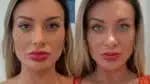 Ceratoplastia pigmentar: compreenda os riscos da cirurgia para alterar a cor dos olhos