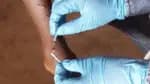 Organização Mundial da Saúde eleva a situação de emergência internacional devido ao surto de mpox