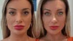 Andressa Urach relata sentir dor após cirurgia para alterar a cor dos olhos: “Estou arrependida de ter feito”