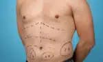 Peito grande em homens: causas, desconfortos e quando a cirurgia é recomendada
