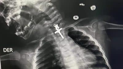 Imagem do post Um raio-X mostrou um crucifixo preso na garganta de um bebê de 10 meses no Peru