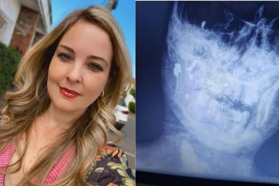 Cantor preso: raio-x mostra que dentista queimada foi baleada no rosto