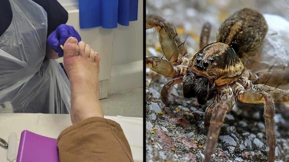 Um homem afirmou que uma aranha picou seu pé e botou ovos lá, mas um especialista rejeitou essa hipótese
